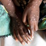 Madagascar confirms first Mpox death as cases rise