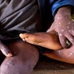 Siaya County issues urgent alert after anthrax outbreak in Vihiga